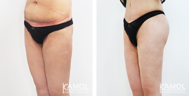 Before & After Thigh Lift