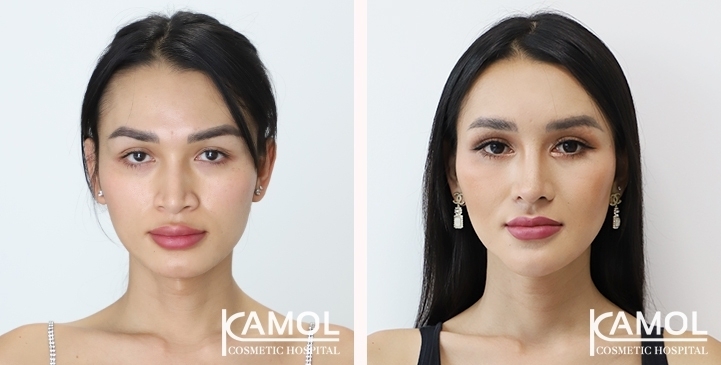 얼굴 여성화 성형수술 / FFS 전후 사진