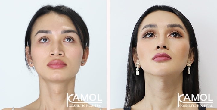 얼굴 여성화 성형수술 / FFS 전후 사진