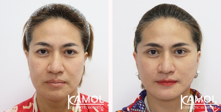 Before & After Facelift / Neck Lift