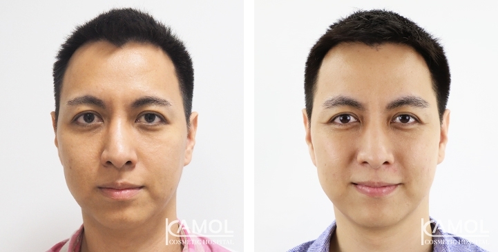 Before & After Forehead Lift / Browlift / Temporal Lift