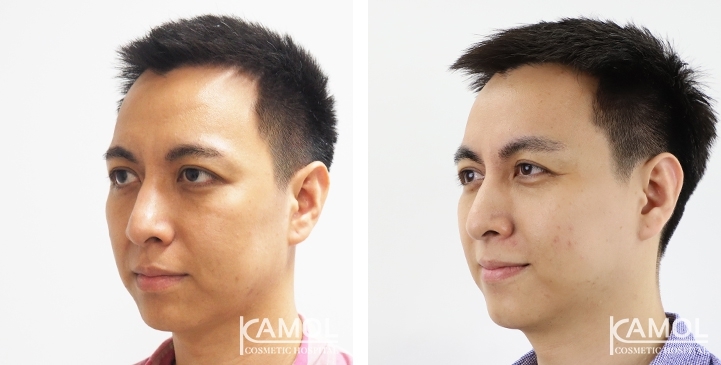 Before & After Forehead Lift / Browlift / Temporal Lift