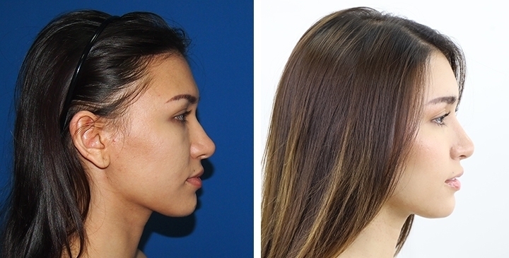 Before & After Cheekbone Reduction, Zygoma Reduction 