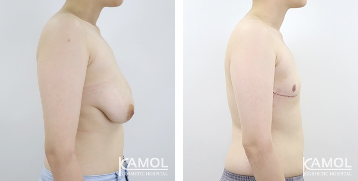 Before and After Female to Male Mastectomy (Top Surgery)