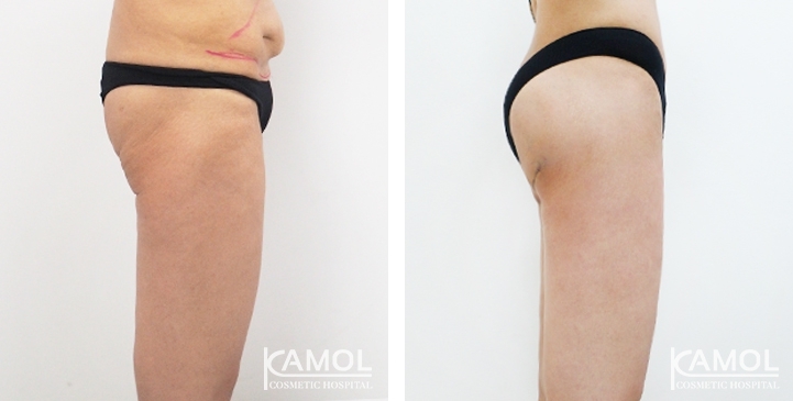 Before & After Thigh Lift