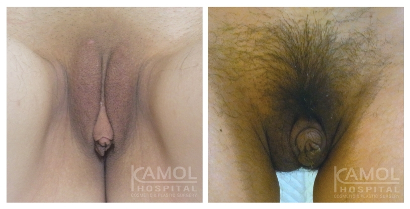 Antes y Después de la Metoidioplastia