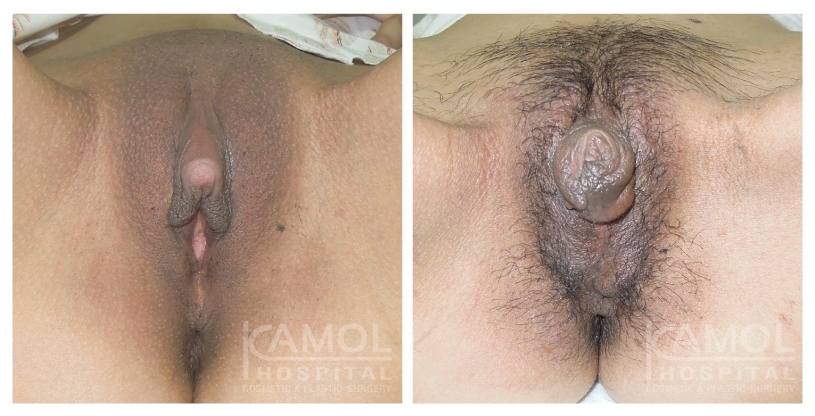 Antes y Después de la Metoidioplastia
