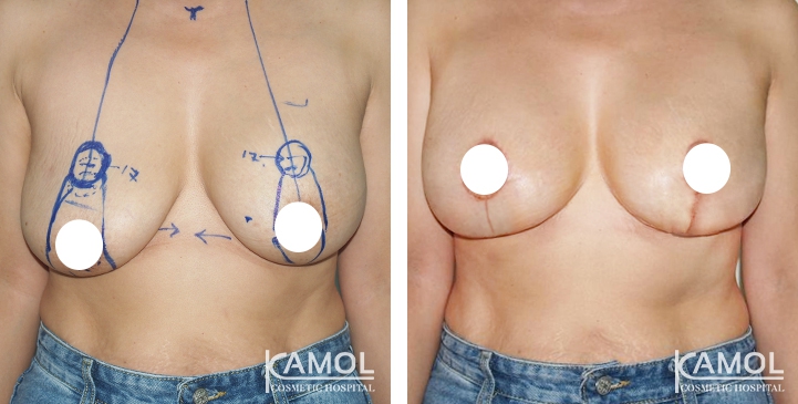 Breast Lift by Inverted T-scar 