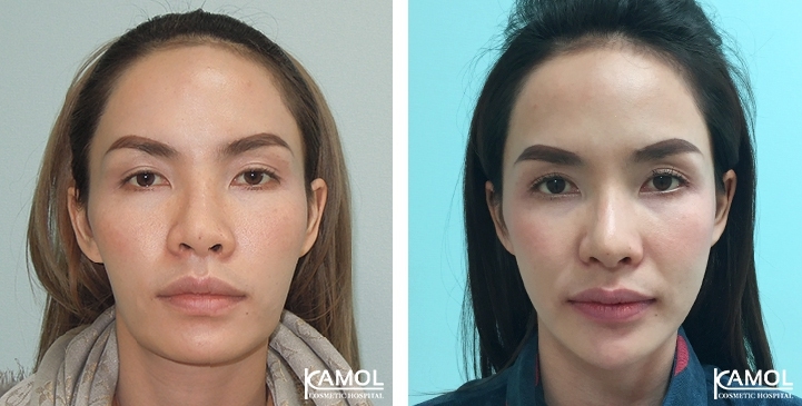 Before and After Cheekbone Reduction / Zygoma reduction / Chin Reduction