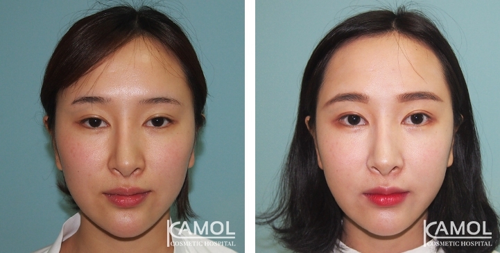 Before and After Cheekbone Reduction / Zygoma reduction
