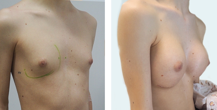 Male to Female Breast Surgery