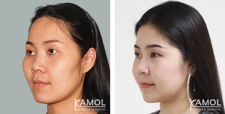 Before and After Cheekbone Reduction / Zygoma reduction