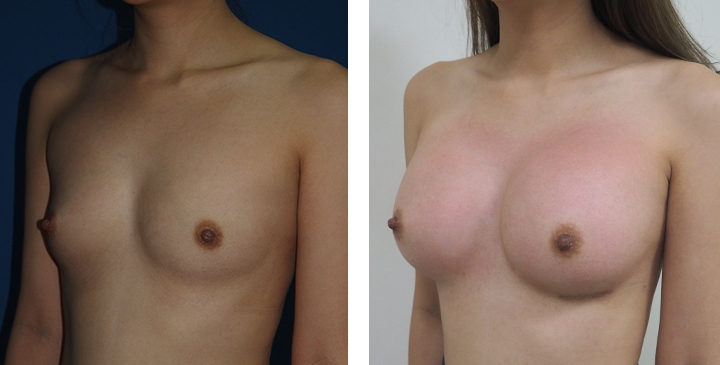 Male to Female Breast Surgery