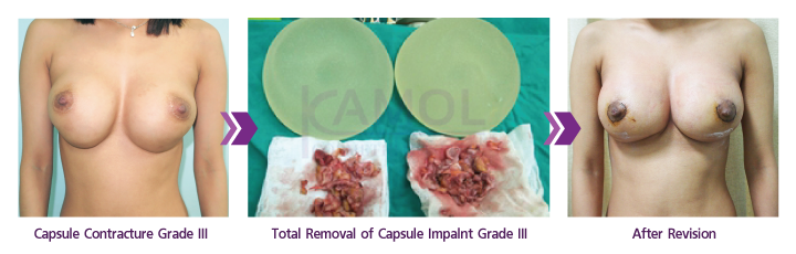 Removal_of_Capsule_Impalnt_Grade 