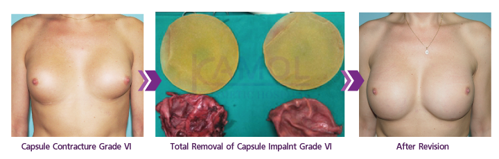 Removal_of_Capsule_Impalnt_Grade