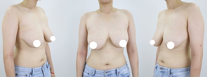 D_Cup_to_Braless