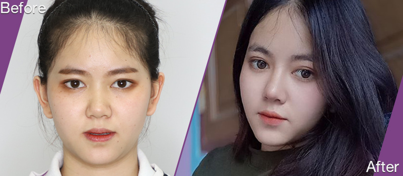 before_and_after_Rhinoplasty