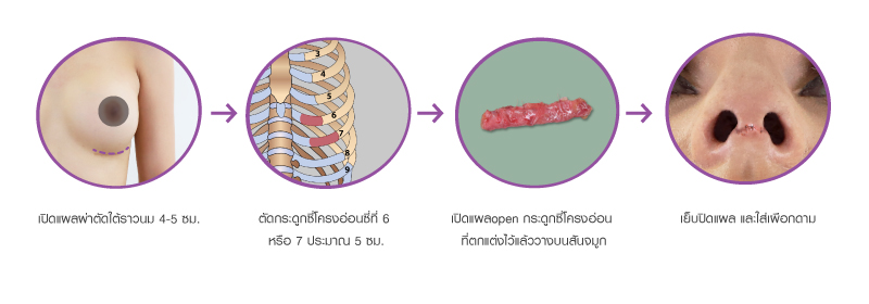 Kamol_Cosmetic_Hospital’s_rib_cartilage_rhinoplasty_technique