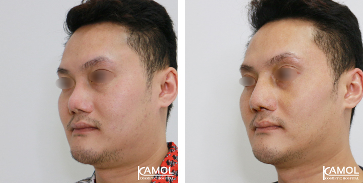 Before_&_After_Rhinoplasty