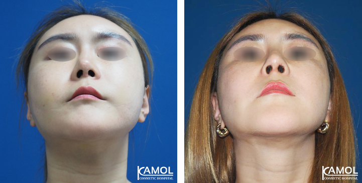 Before  & After Rhinoplasty