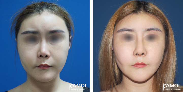 Before_&_After_Rhinoplasty