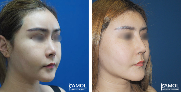 Before_&_After_Rhinoplasty