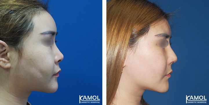 Before_&_After_Rhinoplasty