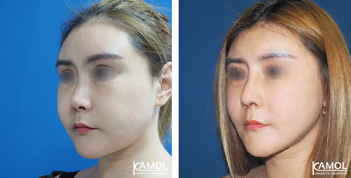 Before_&_After_Rhinoplasty