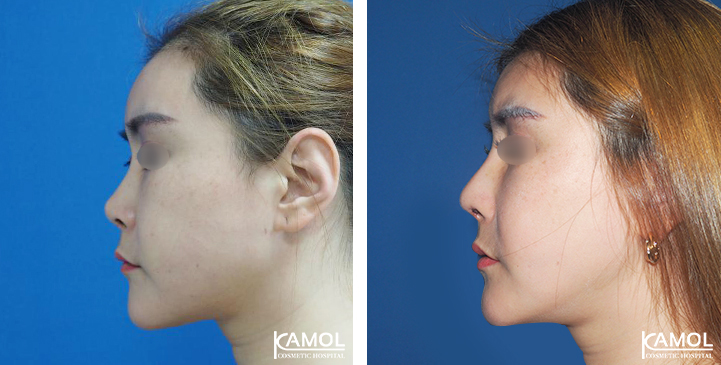 Before_&_After_Rhinoplasty