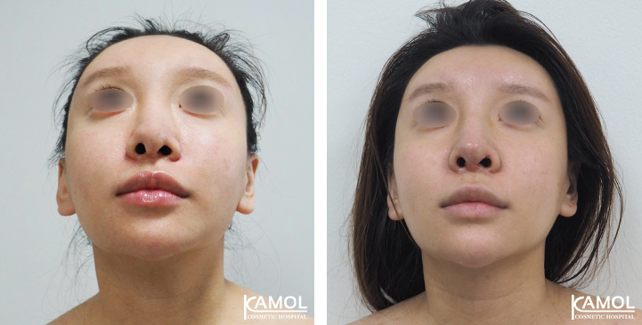 Before_&_After_Rhinoplasty