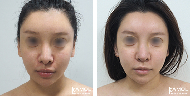 Before  & After Rhinoplasty