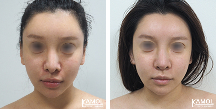 Before_&_After_Rhinoplasty