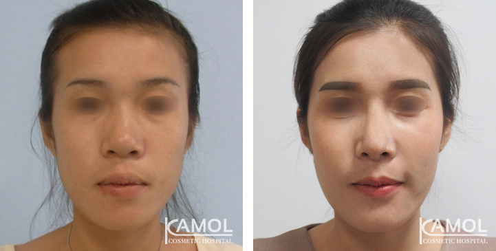 Before_&_After_Rhinoplasty