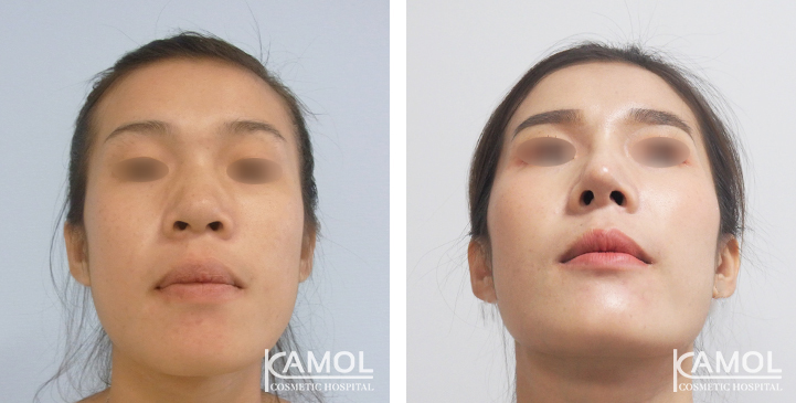 Before_&_After_Rhinoplasty