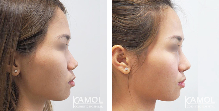 Before_&_After_Rhinoplasty