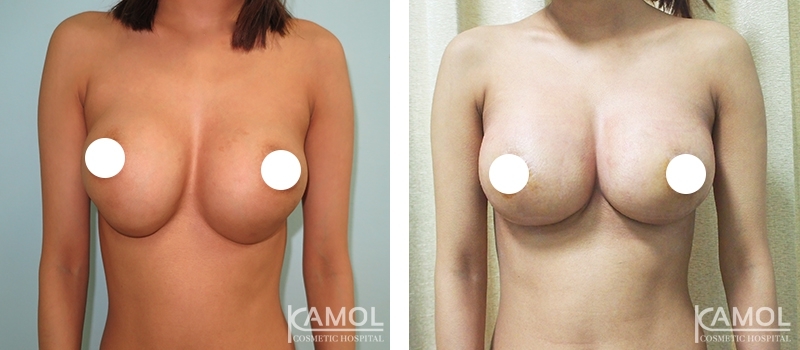 Before_and_After_Reconstruction_surgery_to_fix_capsular_contracture