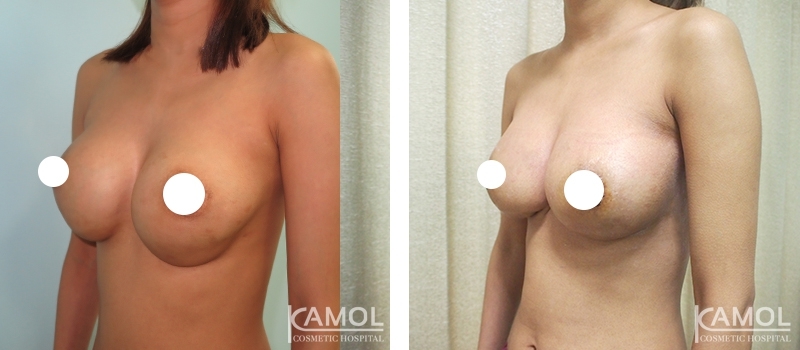 Before_and_After_Reconstruction_surgery_to_fix_capsular_contracture