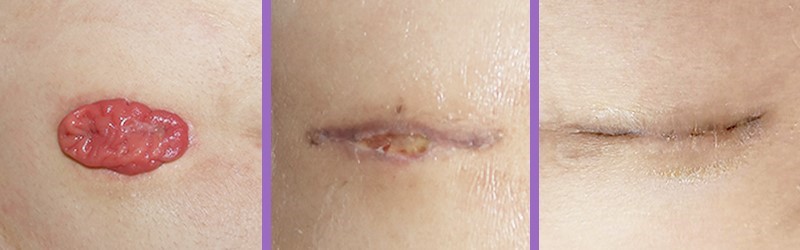 Before_Surgery_After_Surgery_(7_Days)_After_Surgery_(1_Month)