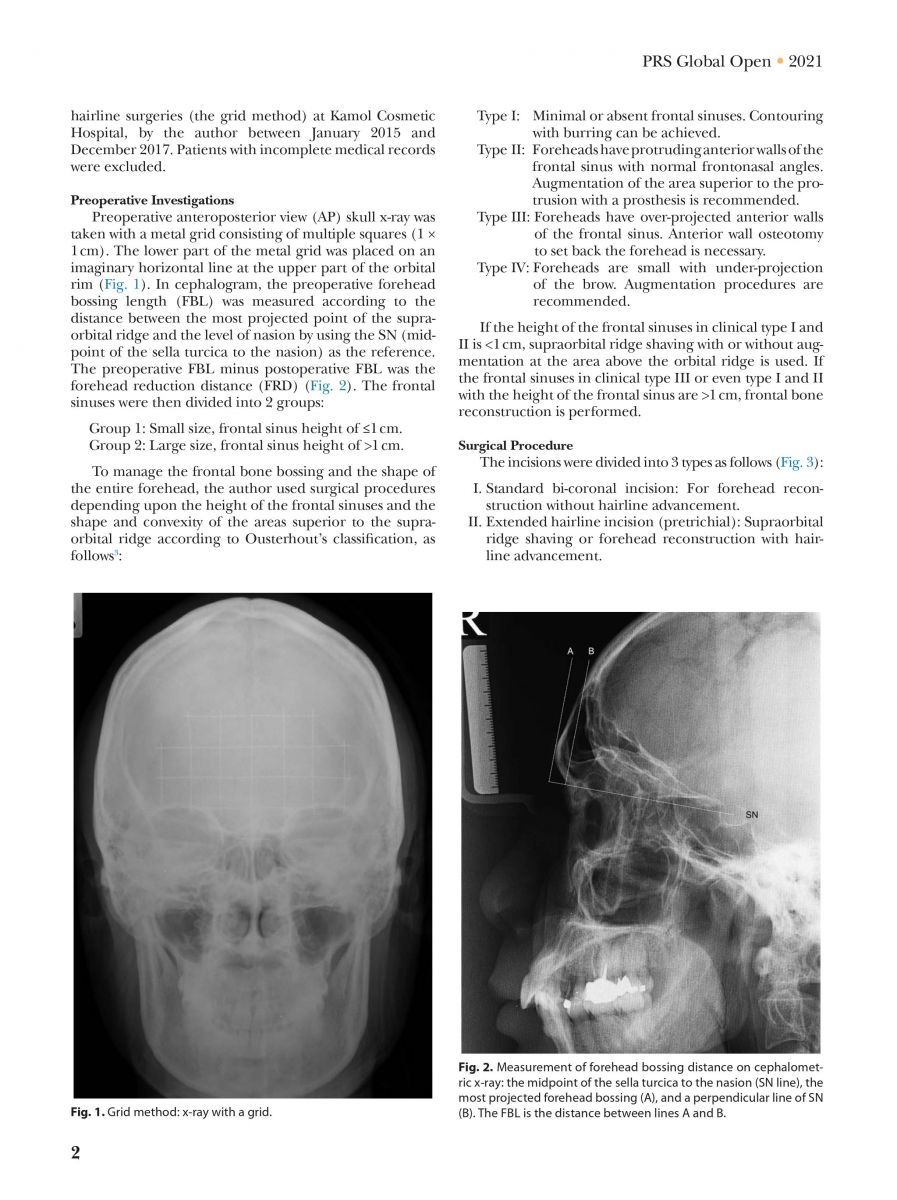 Pansritum,_Kamol_MD._(2021)._Forehead_and_Hairline_Surgery_for_Gender_Affirmation_Plastic_and_Reconstruction_Surgery_Journal