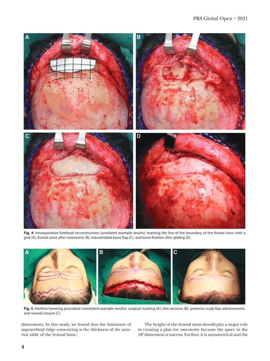 Pansritum,_Kamol_MD._(2021)._Forehead_and_Hairline_Surgery_for_Gender_Affirmation_Plastic_and_Reconstruction_Surgery_Journal