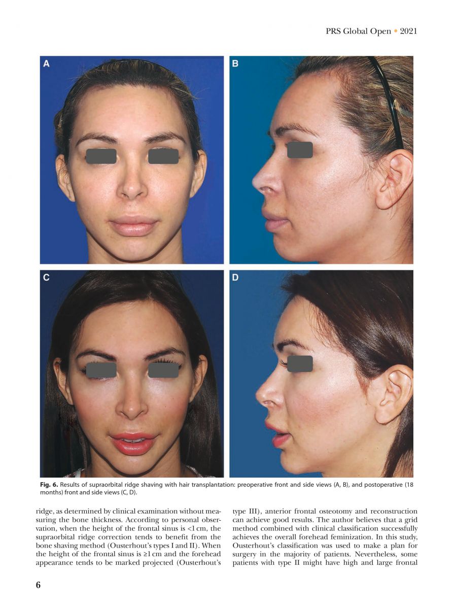 Pansritum,_Kamol_MD._(2021)._Forehead_and_Hairline_Surgery_for_Gender_Affirmation_Plastic_and_Reconstruction_Surgery_Journal