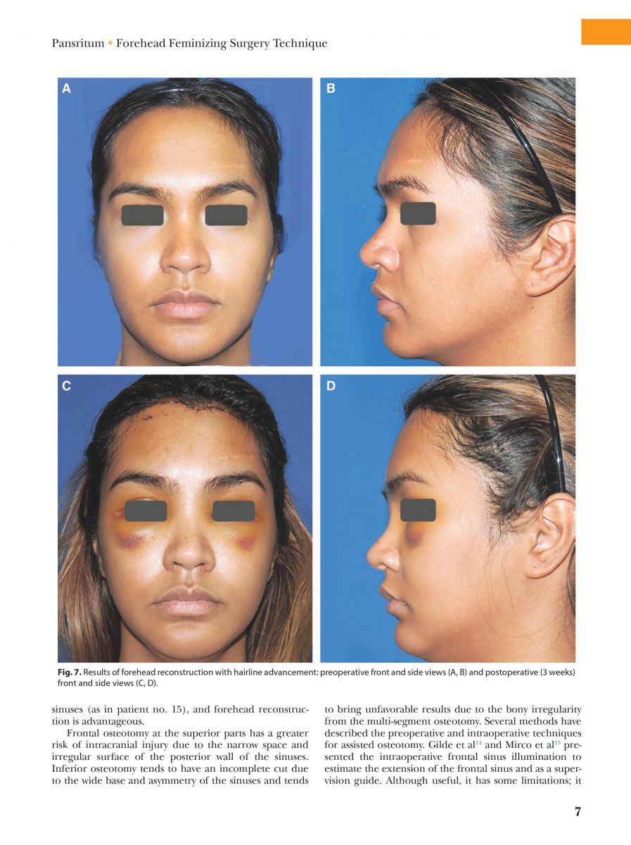 Pansritum,_Kamol_MD._(2021)._Forehead_and_Hairline_Surgery_for_Gender_Affirmation_Plastic_and_Reconstruction_Surgery_Journal