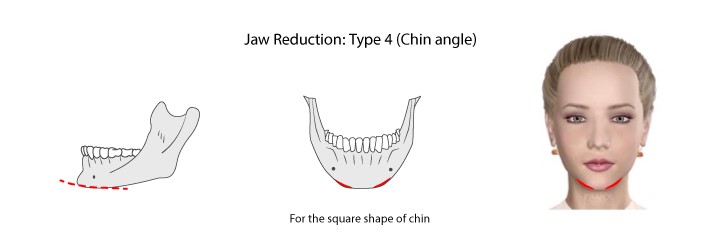 jaw_reduction_type_4
