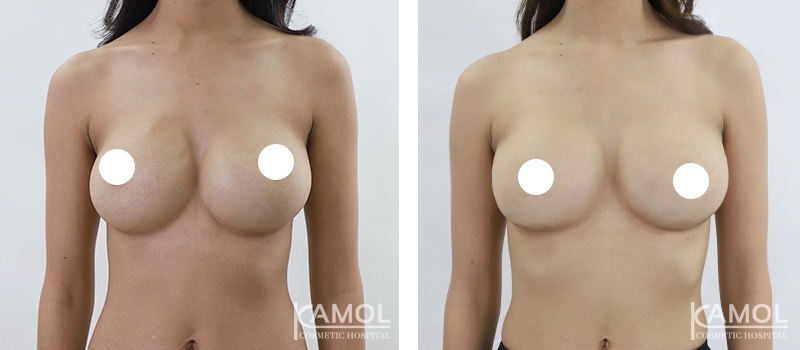 Before_and_After_surgery