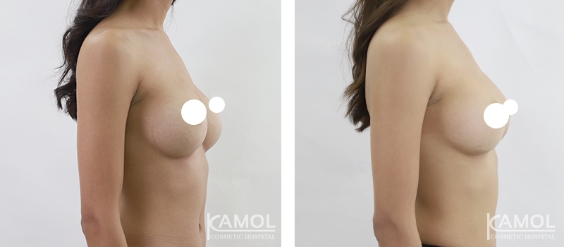 Before_and_After_surgery