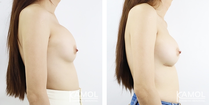 Before_and_After_surgery