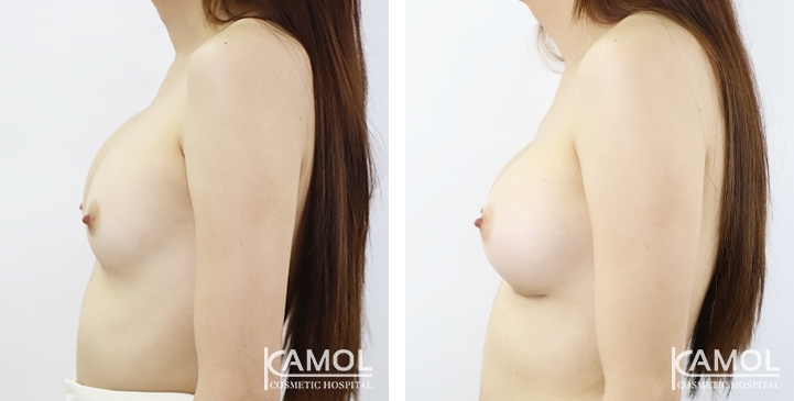 Before_and_After_surgery