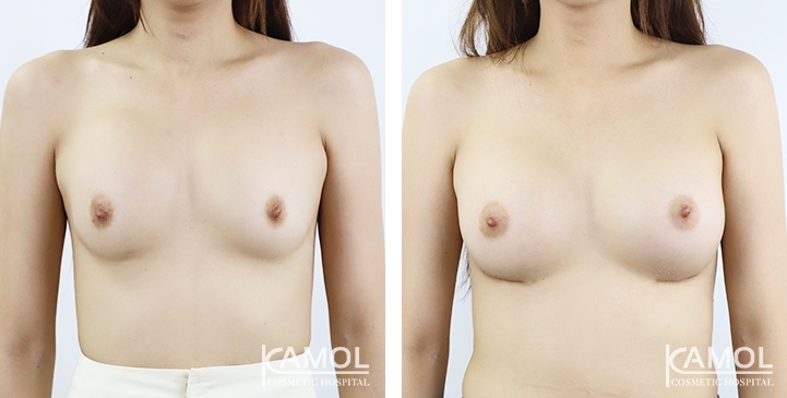 Before_and_After_surgery
