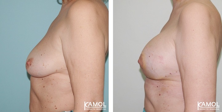Before_and_After_surgery