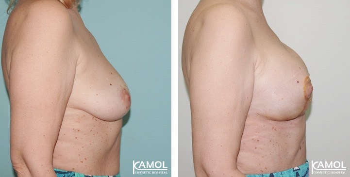 Before_and_After_surgery
